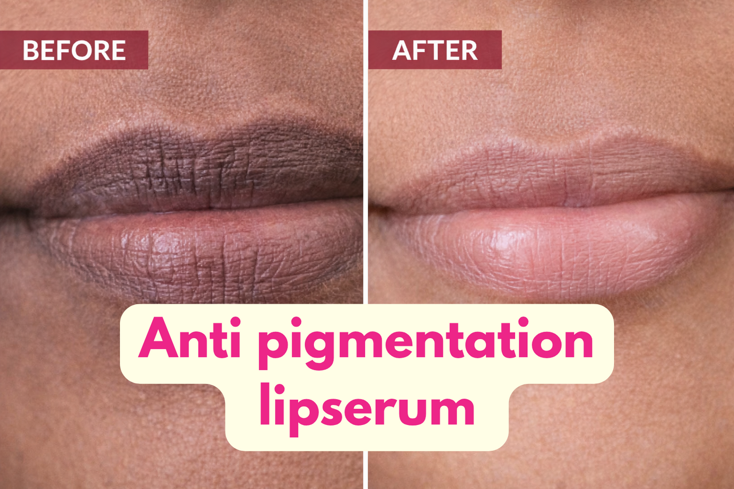 Anti -Pigmentation Lip Serum